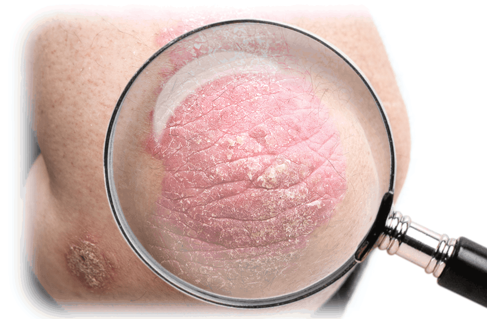 Psoriasis Practice Reflective